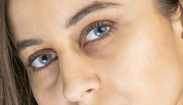 Göz altı morlukları tedavisinde yeni bir yöntem
